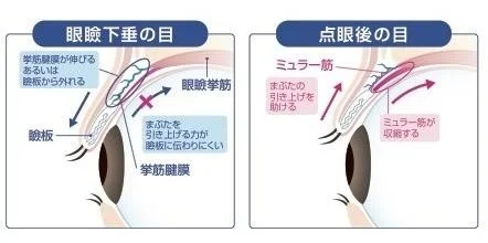 アップニークの仕組み