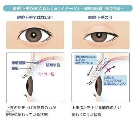 眼瞼下垂の仕組み